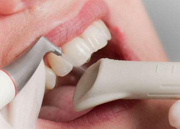 AIR FLOW – очистка зубов специальным стоматологическим оборудованием