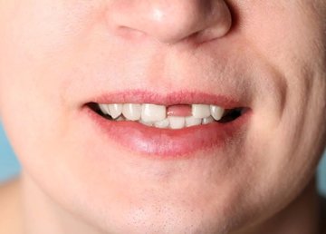 Первая помощь при выбитом зубе: что делать и как сохранить зуб