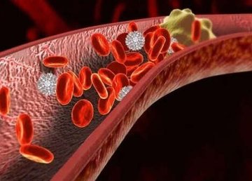 Среди харьковчан участились случаи тромбоза. Как избежать осложнений
