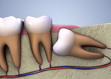 Удаление зубов мудрости: что нужно знать о процедуре и возможных осложнениях