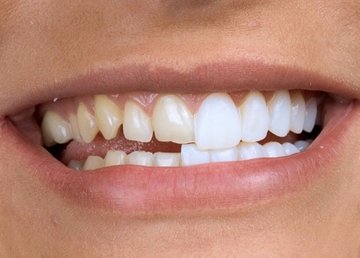 Виниры — красивая улыбка на всю жизнь: особенности, плюсы и минусы Виниры — красивая улыбка на всю жизнь: особенности, плюсы и минусы