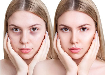 Як прибрати синці під очима Як прибрати синці під очима